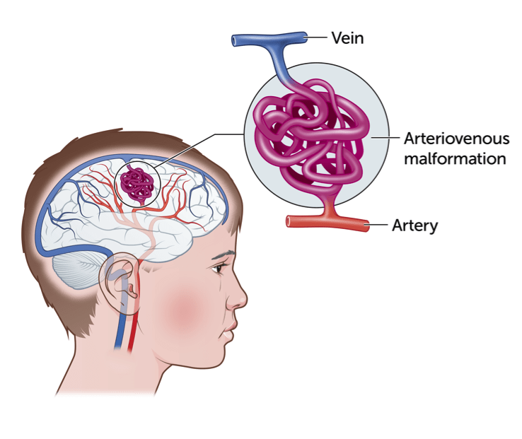 Arteriovenosus Malformation Unitamed