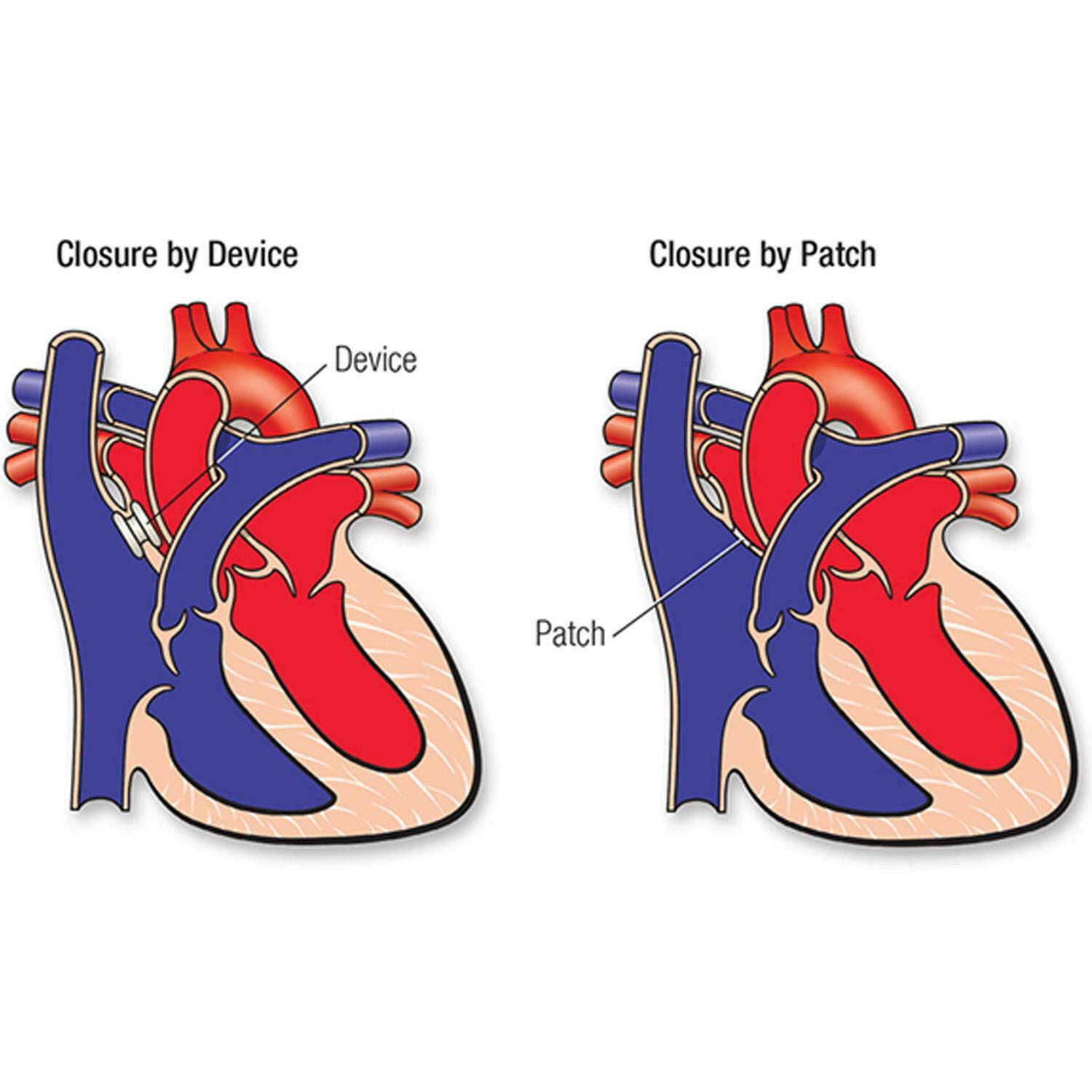 atrial-septal-defect-unitamed