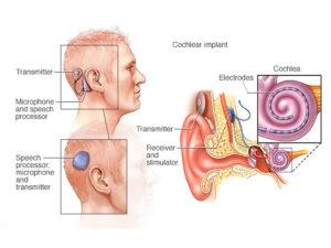 COCHLEAR IMPLANT