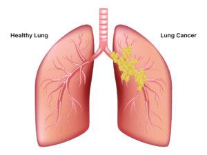 Lung-Cancer-1