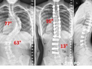 SCOLIOSIS TREATMENT