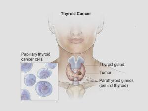 THYROID CANCER