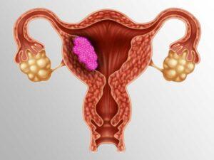 uterine-cancer